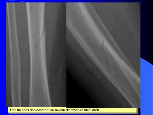 FRACTURES DE L'ENFANT