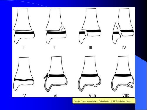 FRACTURES DE L'ENFANT