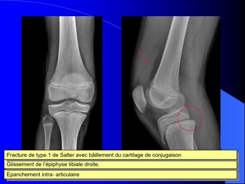 FRACTURES DE L'ENFANT