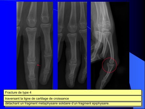 FRACTURES DE L'ENFANT