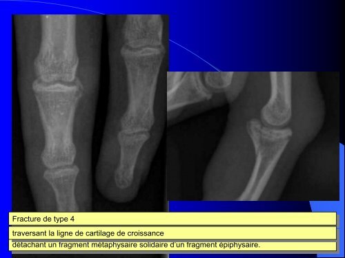 FRACTURES DE L'ENFANT