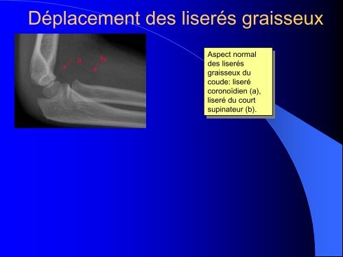 FRACTURES DE L'ENFANT