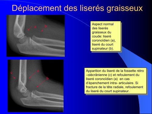 FRACTURES DE L'ENFANT