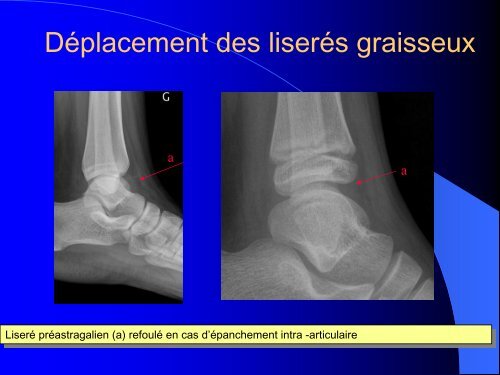 FRACTURES DE L'ENFANT