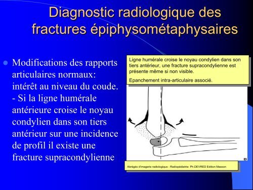 FRACTURES DE L'ENFANT