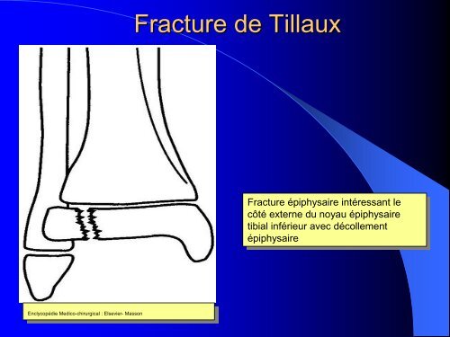 FRACTURES DE L'ENFANT