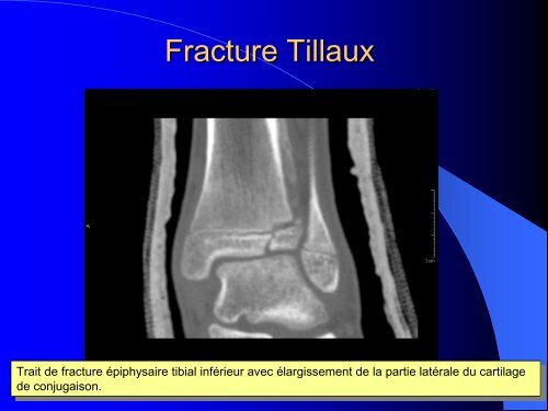 FRACTURES DE L'ENFANT