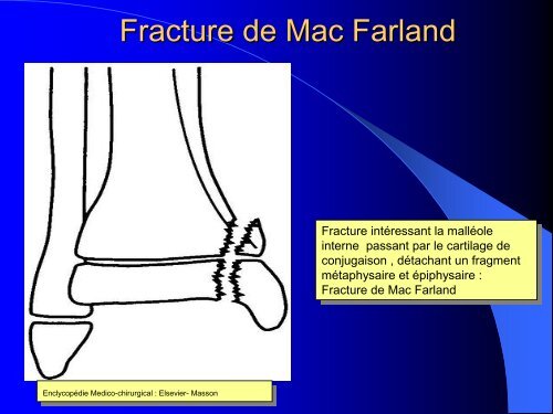 FRACTURES DE L'ENFANT