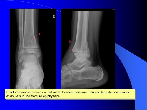 FRACTURES DE L'ENFANT