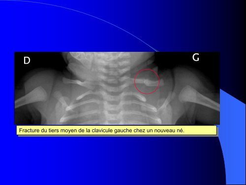 FRACTURES DE L'ENFANT