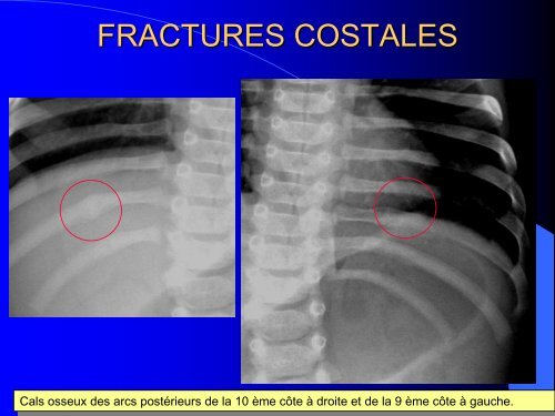 FRACTURES DE L'ENFANT