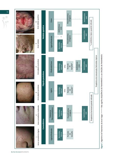 AvaliaÃ§Ã£o e tratamento do doente com acne â Parte II: - SciELO