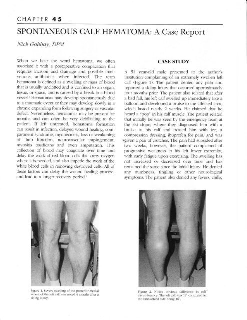 Spontaneous Calf Hematoma - The Podiatry Institute