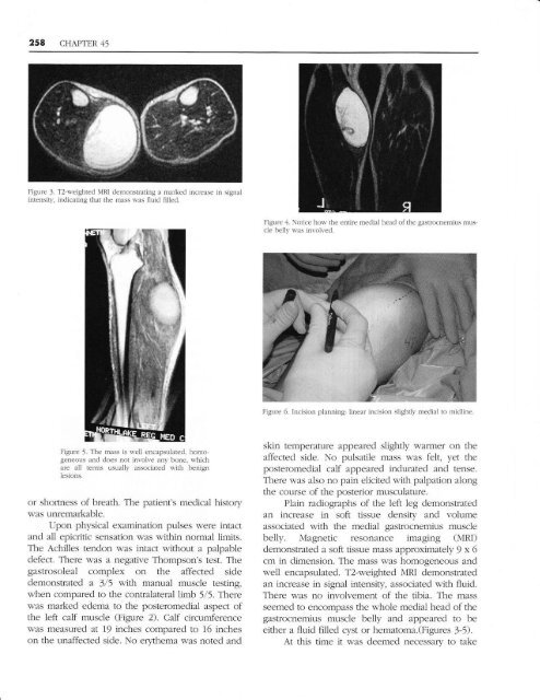 Spontaneous Calf Hematoma - The Podiatry Institute