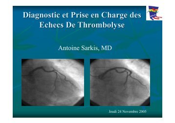 Diagnostic et Prise en Charge des Echecs De Thrombolyse