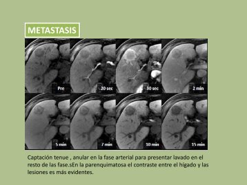 metastasis colorectal