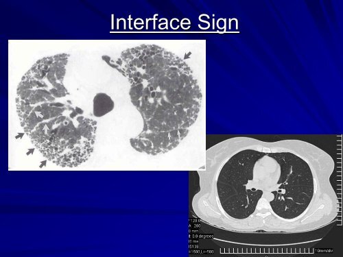 High resolution CT in Interstitial Lung Diseasesby Dr