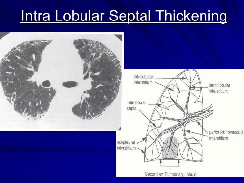 High resolution CT in Interstitial Lung Diseasesby Dr