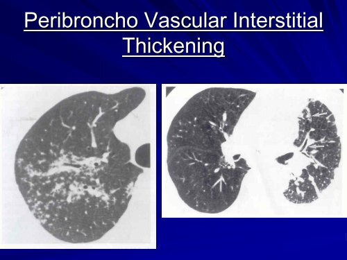 High resolution CT in Interstitial Lung Diseasesby Dr