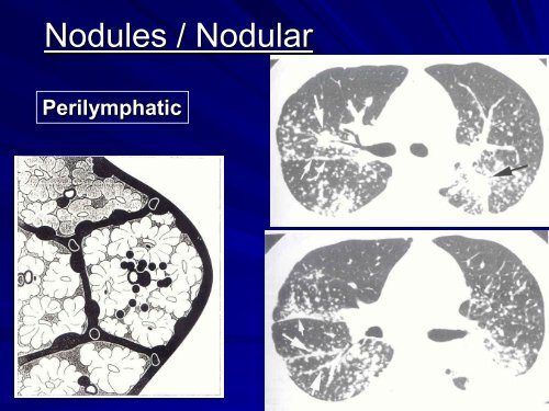 High resolution CT in Interstitial Lung Diseasesby Dr