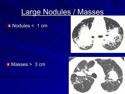 High resolution CT in Interstitial Lung Diseasesby Dr