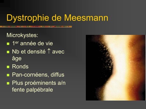 Les dystrophies cornÃ©ennes - Bbarthelemy.com