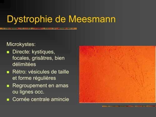 Les dystrophies cornÃ©ennes - Bbarthelemy.com