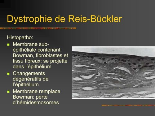 Les dystrophies cornÃ©ennes - Bbarthelemy.com