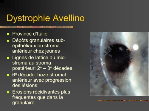 Les dystrophies cornÃ©ennes - Bbarthelemy.com