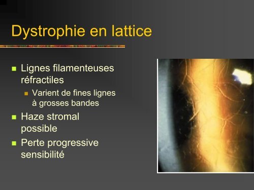 Les dystrophies cornÃ©ennes - Bbarthelemy.com