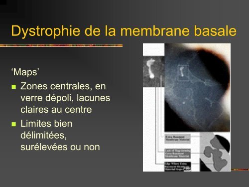 Les dystrophies cornÃ©ennes - Bbarthelemy.com