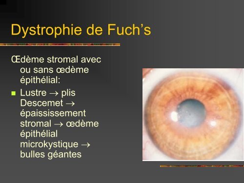 Les dystrophies cornÃ©ennes - Bbarthelemy.com