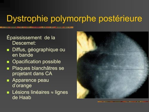 Les dystrophies cornÃ©ennes - Bbarthelemy.com