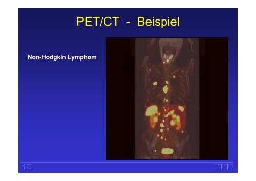 Molekulare Bildgebung mit PET (H. Harke)