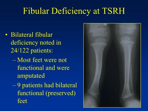 Congenital Short limb - CHU Sainte-Justine - SAAC