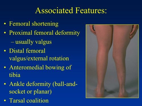 Congenital Short limb - CHU Sainte-Justine - SAAC