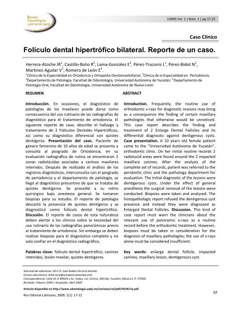 FolÃ­culo dental hipertrÃ³fico bilateral. Reporte de un caso.