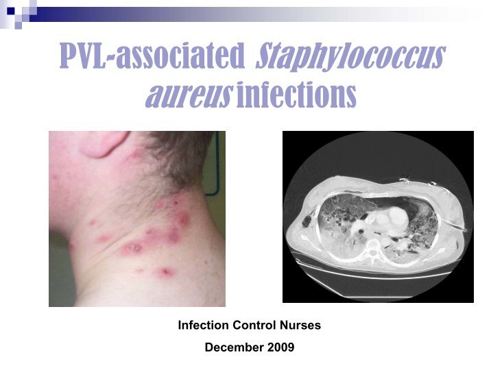 Skin and Soft Tissue Infections Caused By Staph Aureus ...