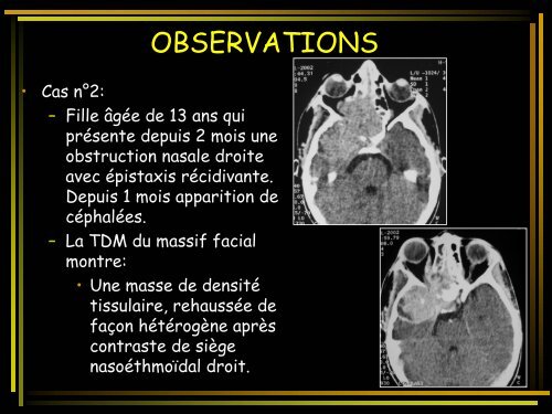 PNET DES FOSSES NASALES : UNE LOCALISATION ...