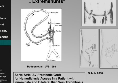 Vortrag (PDF-Datei) - Dialyseshunt