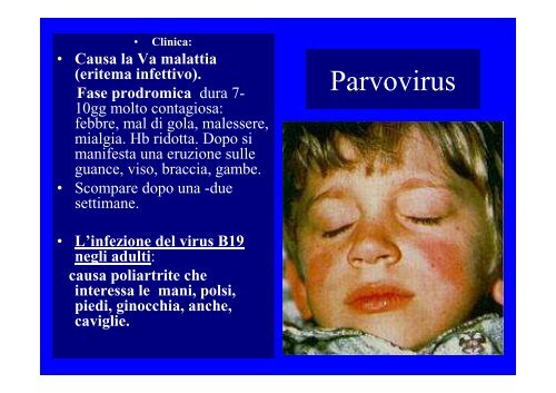 Parvovirus