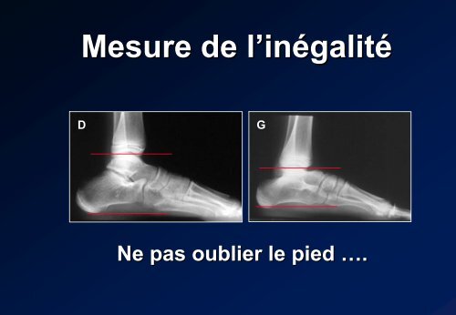 Desepiphysiodesis Technique. Indications. J C ... - SOFOP