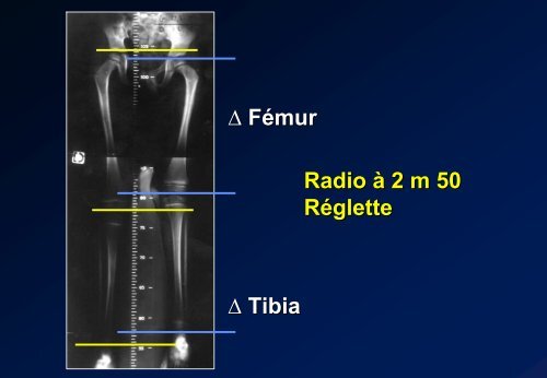 Desepiphysiodesis Technique. Indications. J C ... - SOFOP