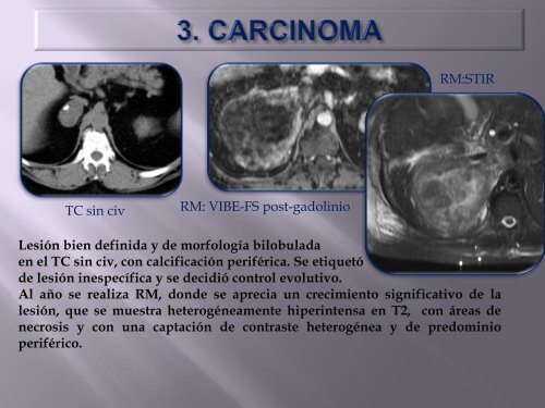 carcinoma suprarrenal