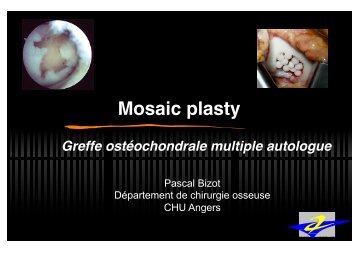 Mosaicplasty genou - ClubOrtho.fr