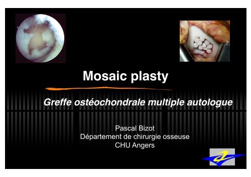 Mosaicplasty genou - ClubOrtho.fr