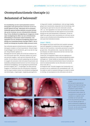 Oromyofunctionele therapie (1) Belastend of belovend? - OMFT