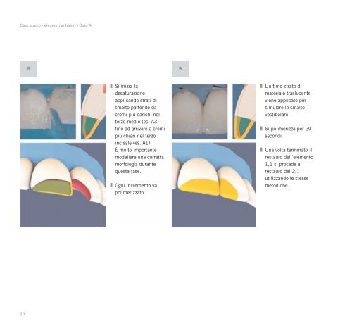 Ricostruzioni estetiche in composito - Heraeus