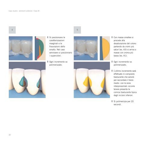 Ricostruzioni estetiche in composito - Heraeus