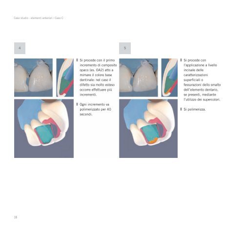 Ricostruzioni estetiche in composito - Heraeus